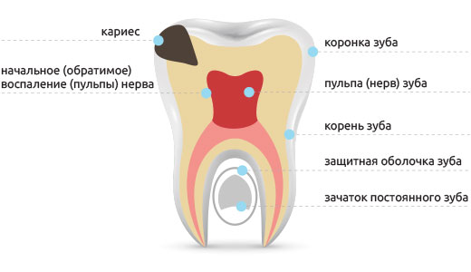 ris3